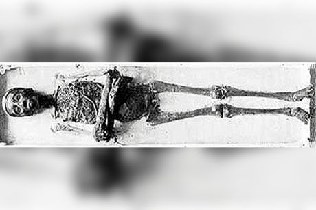 Tutankamon faraon sa deformitetima Tutankamon faraon sa deformitetima