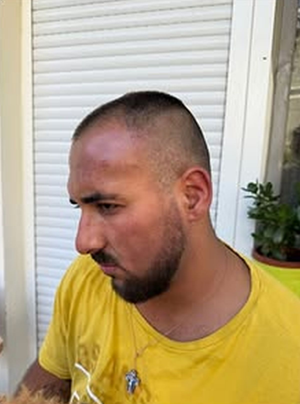 Prve slike brutalno pretučenog zadrugara: Jezive povrede po glavi, pomodreo skroz