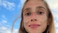 Devojka se izgladnela do smrti, imala je samo 22 kilograma: Živela je isključivo na voću, fotografije su horor