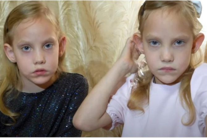 Sijamske bliznakinje Maja i Lija