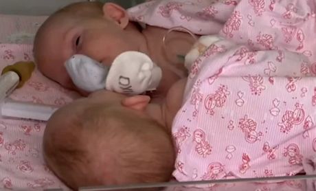 Sijamske bliznakinje Maja i Lija