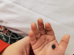 Dete opekotina od punjača