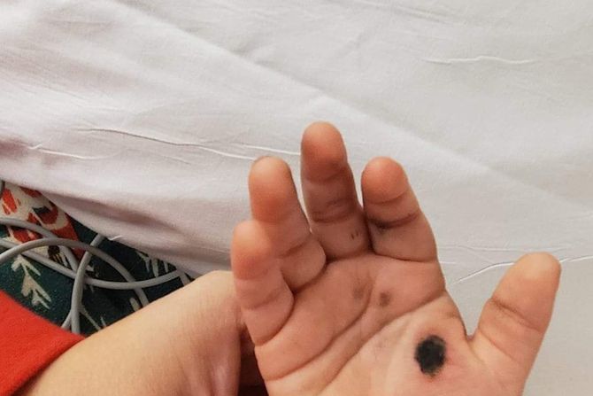 Dete opekotina od punjača Dete opekotina od punjača