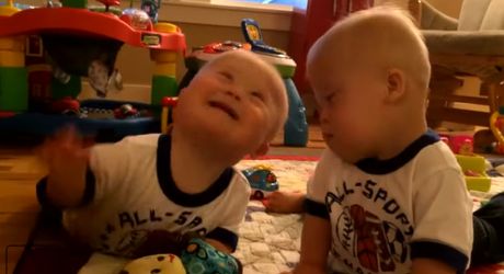 blizanci daunov sindrom