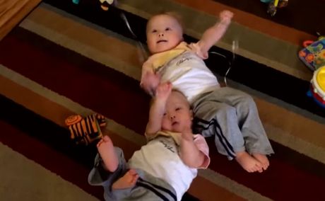 blizanci daunov sindrom