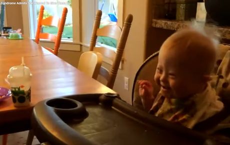 blizanci daunov sindrom