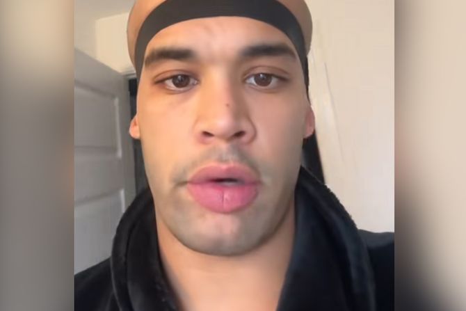 Tansplantacija kose nus pojave