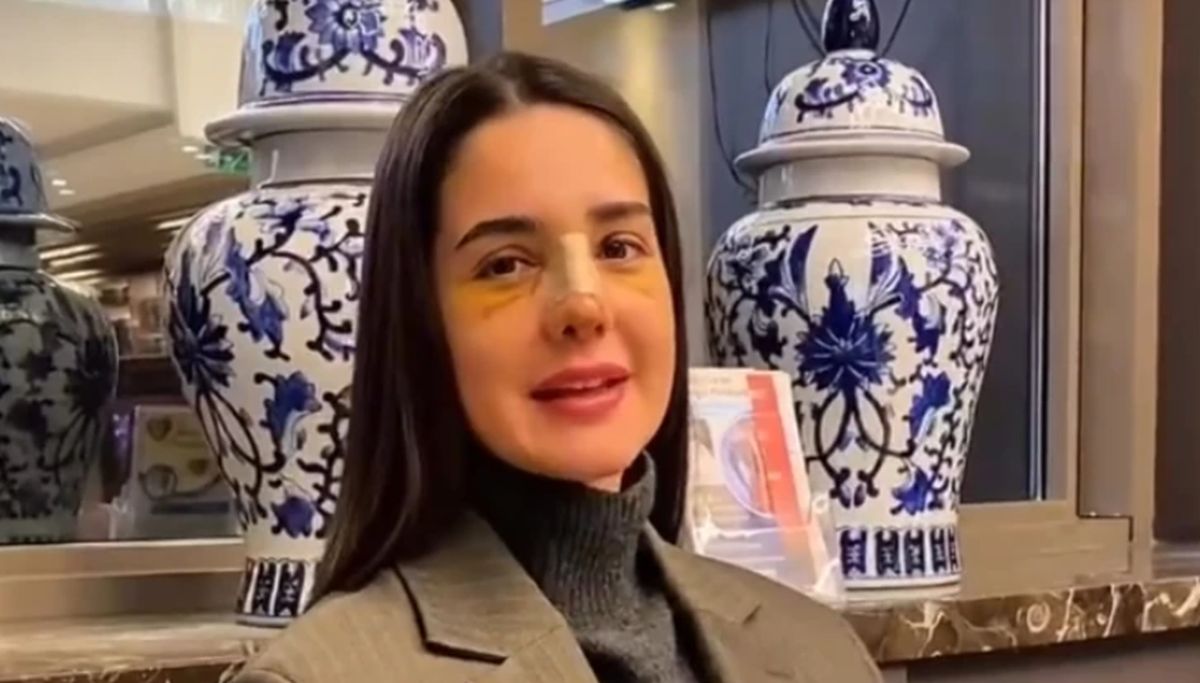 Anđela pokazala prve slike nakon operacije nosa: Oglasila se iz Turske posle intervencije "Suzila sam..."