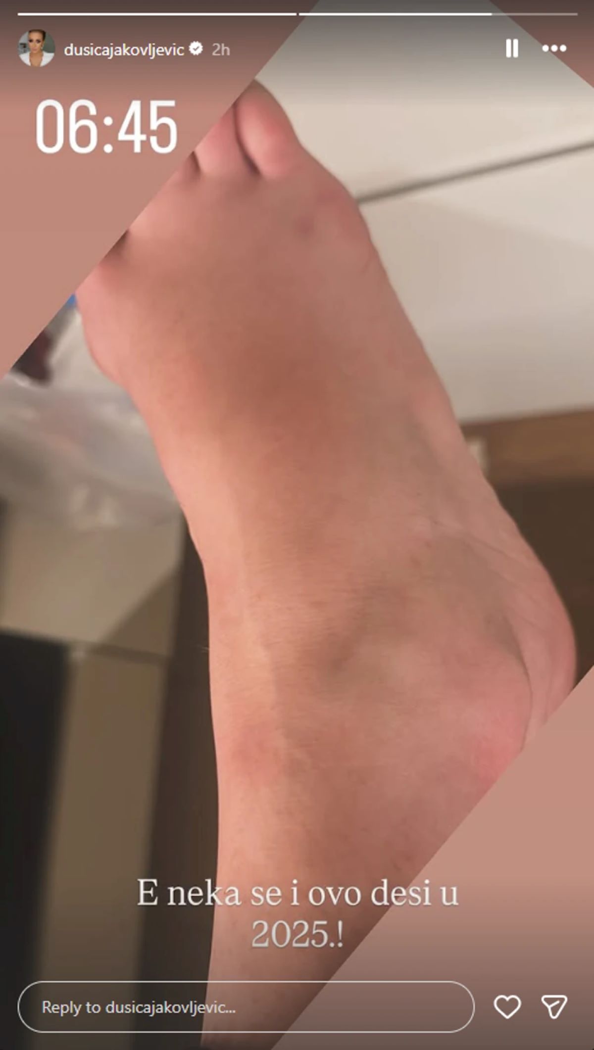 Dušica Jakovljević povredila nogu! Skroz otekla, pokazala kako izgleda: "E, neka se i ovo desi..."