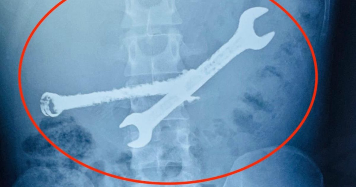 NE ZNAJU KAKO JE ŽIV! Mladić (26) se žalio na bolove u stomaku: Kad je stigao rendgenski snimak, nastao muk