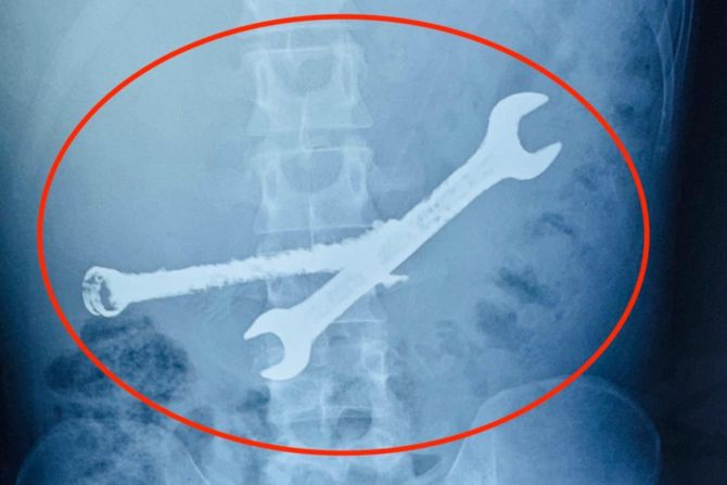 progutao četkice za zube