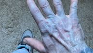 Čovek se probudio plav od glave do pete i hitno završio u bolnici: Koža mu izgleda kao da je upao u farbu!