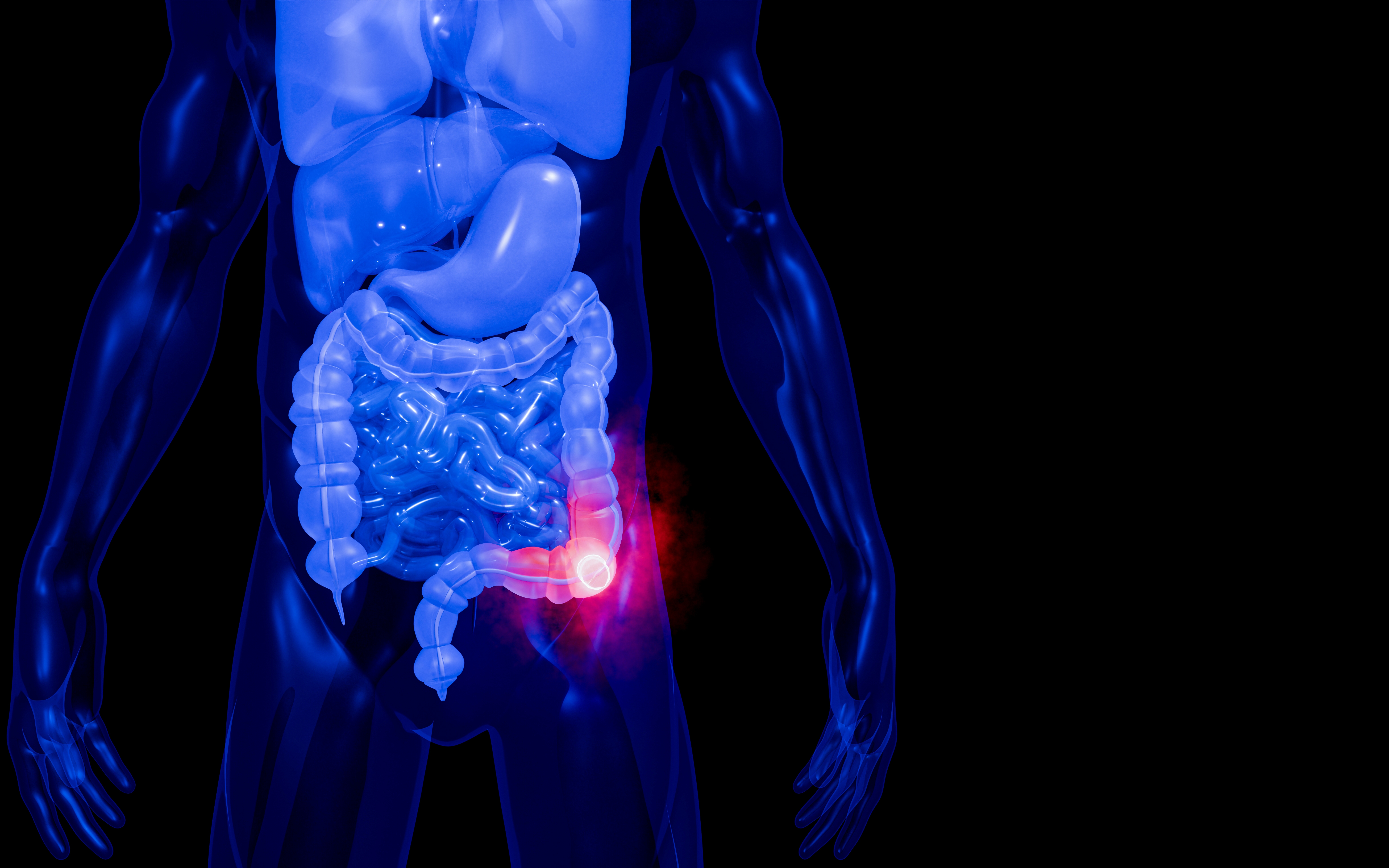 Zašto sve više mlađih ljudi oboleva od raka debelog creva? Epidemiološki obrt zabrinuo naučnike