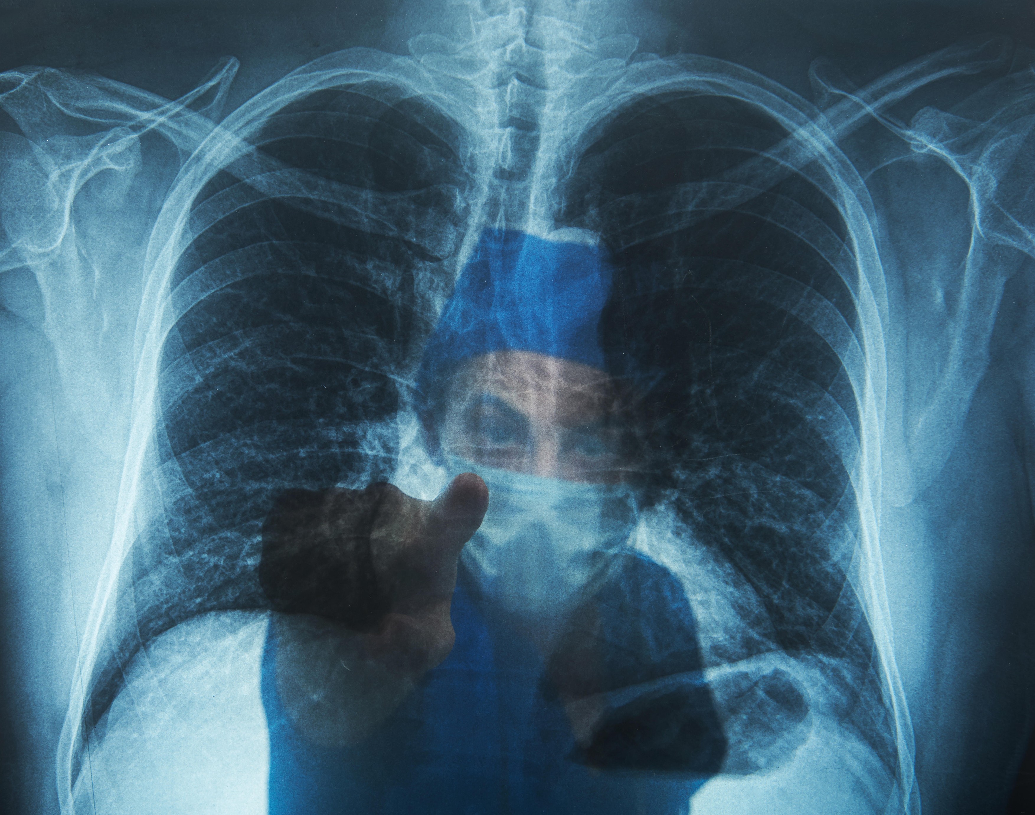 Dogodilo se nemoguće: Pacijent živeo bez pluća punih 48 sati! Neverovatan uspeh hirurga