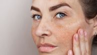 Zašto tamne fleke na licu ne prolaze: 6 grešaka koje skoro svi pravimo