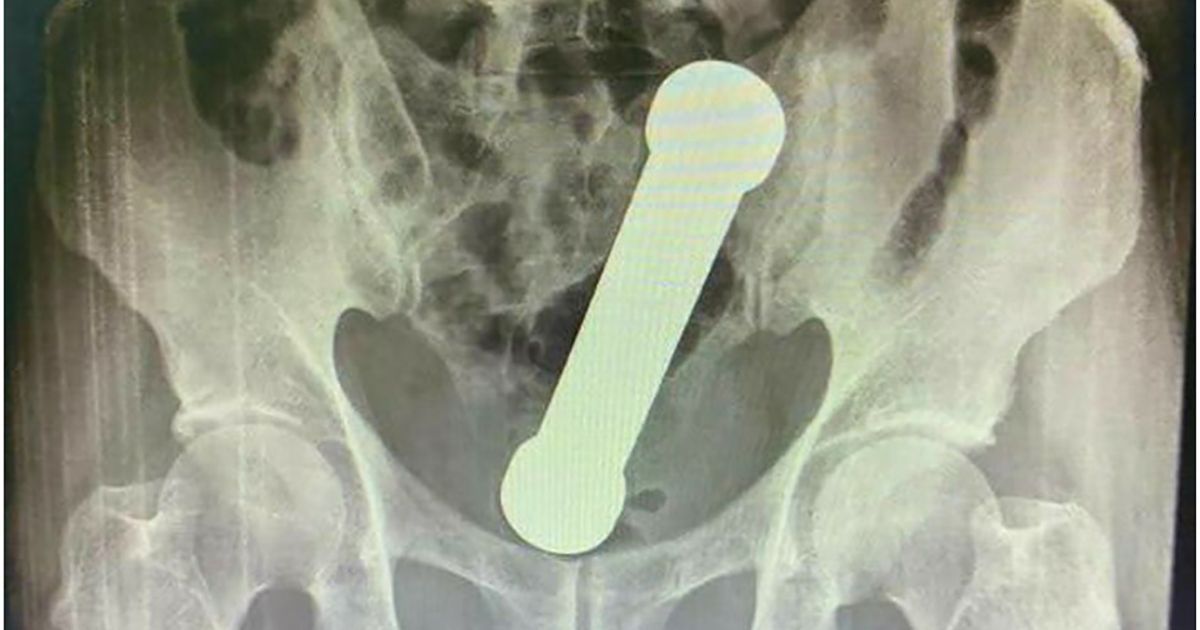 ŽALIO SE NA BOLOVE Lekari zanemeli kad su videli rendgenski snimak: Iz rektuma mu izvađen teg od 2 kilograma!