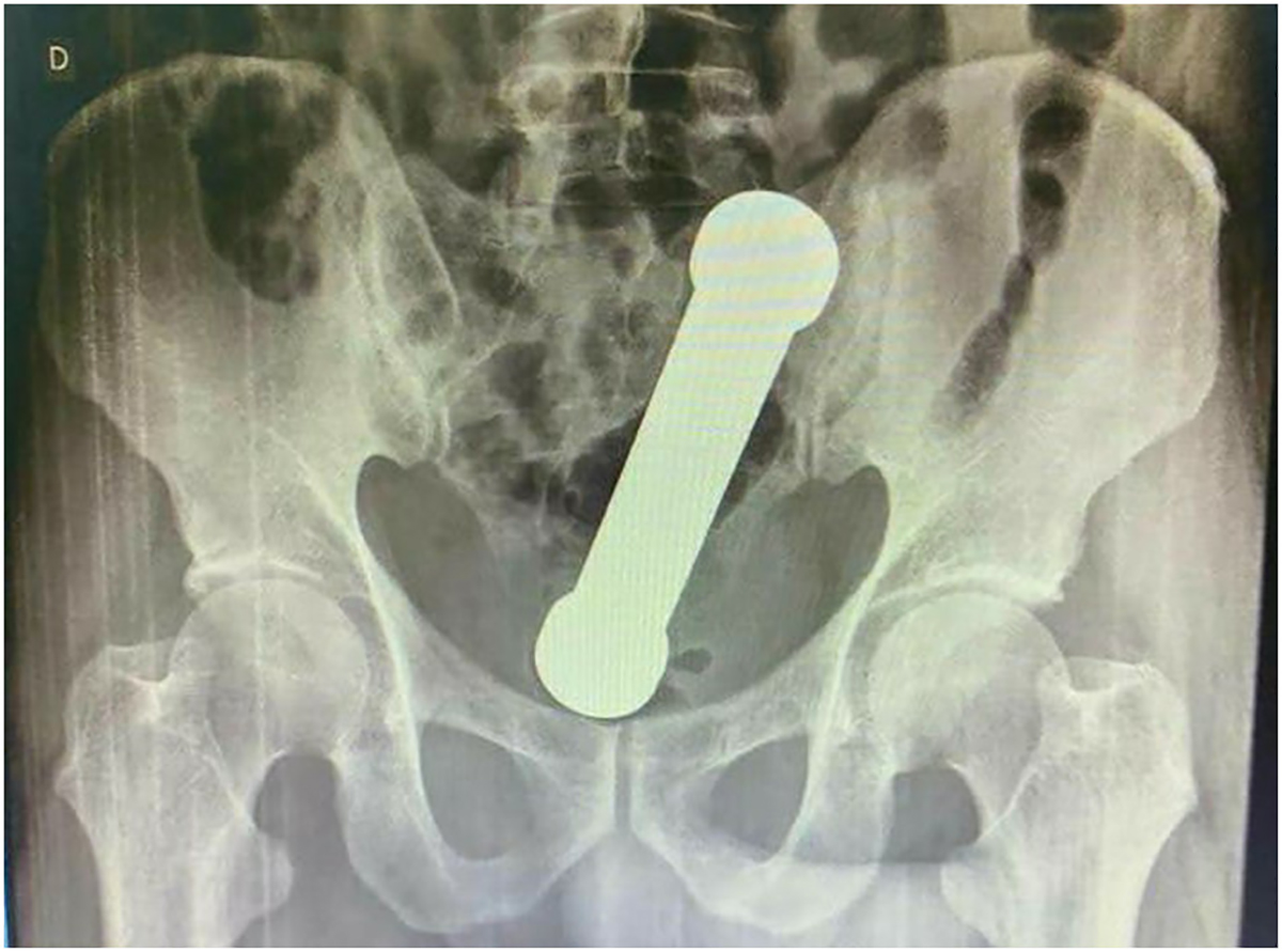 ŽALIO SE NA BOLOVE Lekari zanemeli kad su videli rendgenski snimak: Iz rektuma mu izvađen teg od 2 kilograma!