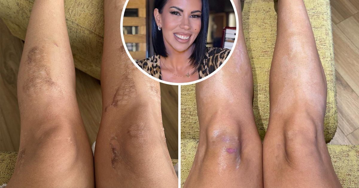 Hristina je otišla na epilaciju, a izašla sa stravičnim opekotinama: 