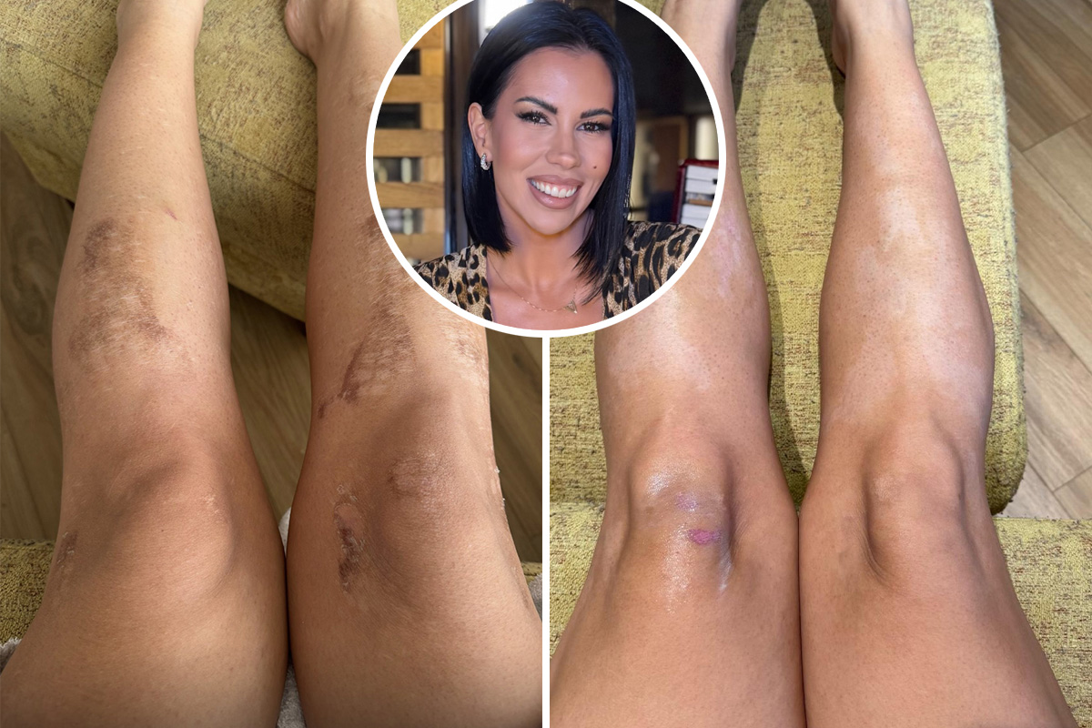 Hristina je otišla na epilaciju, a izašla sa stravičnim opekotinama: "Osam meseci sam krila noge"