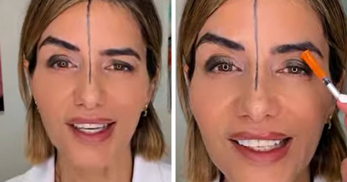 Doktorka ubrizgala botoks u JEDNU STRANU ČELA i pogledajte šta se dogodilo: Ovo je rezultat EKSPERIMENTA