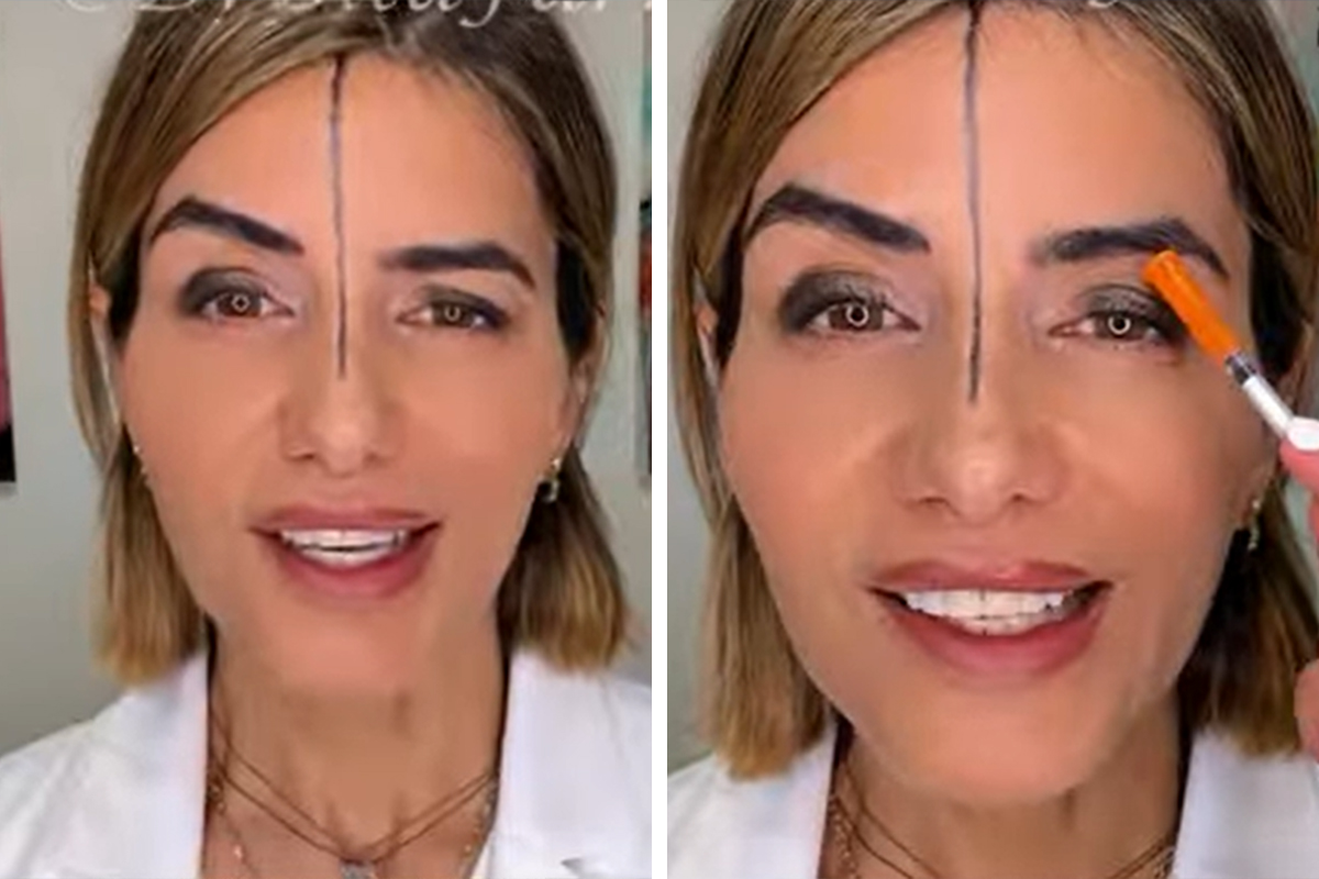 Doktorka ubrizgala botoks u JEDNU STRANU ČELA i pogledajte šta se dogodilo: Ovo je rezultat EKSPERIMENTA