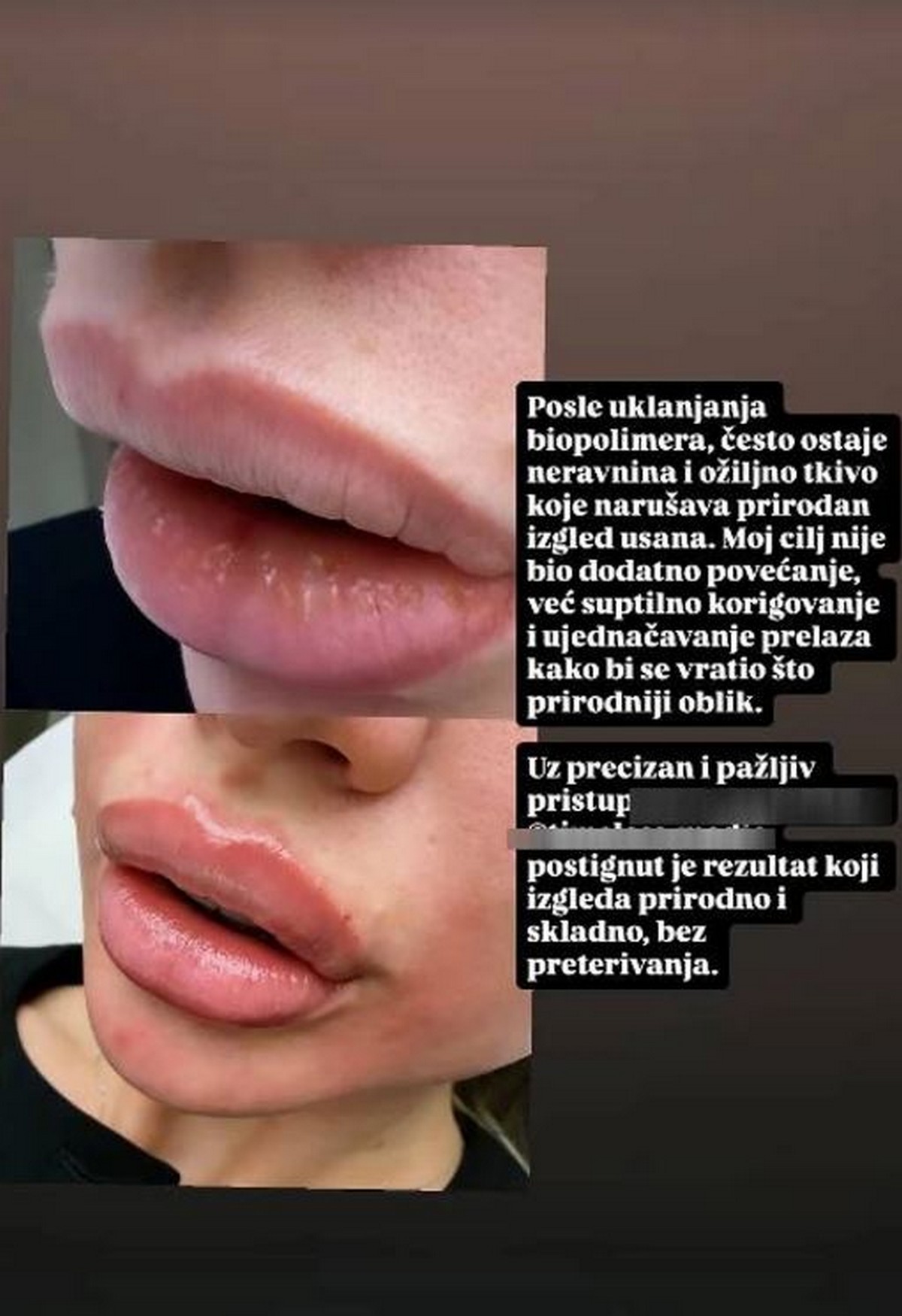 Milica Kemez se oglasila sa klinike: Bivša rijaliti učesnica izvadila bipolimer, pokazala kako sada izgleda