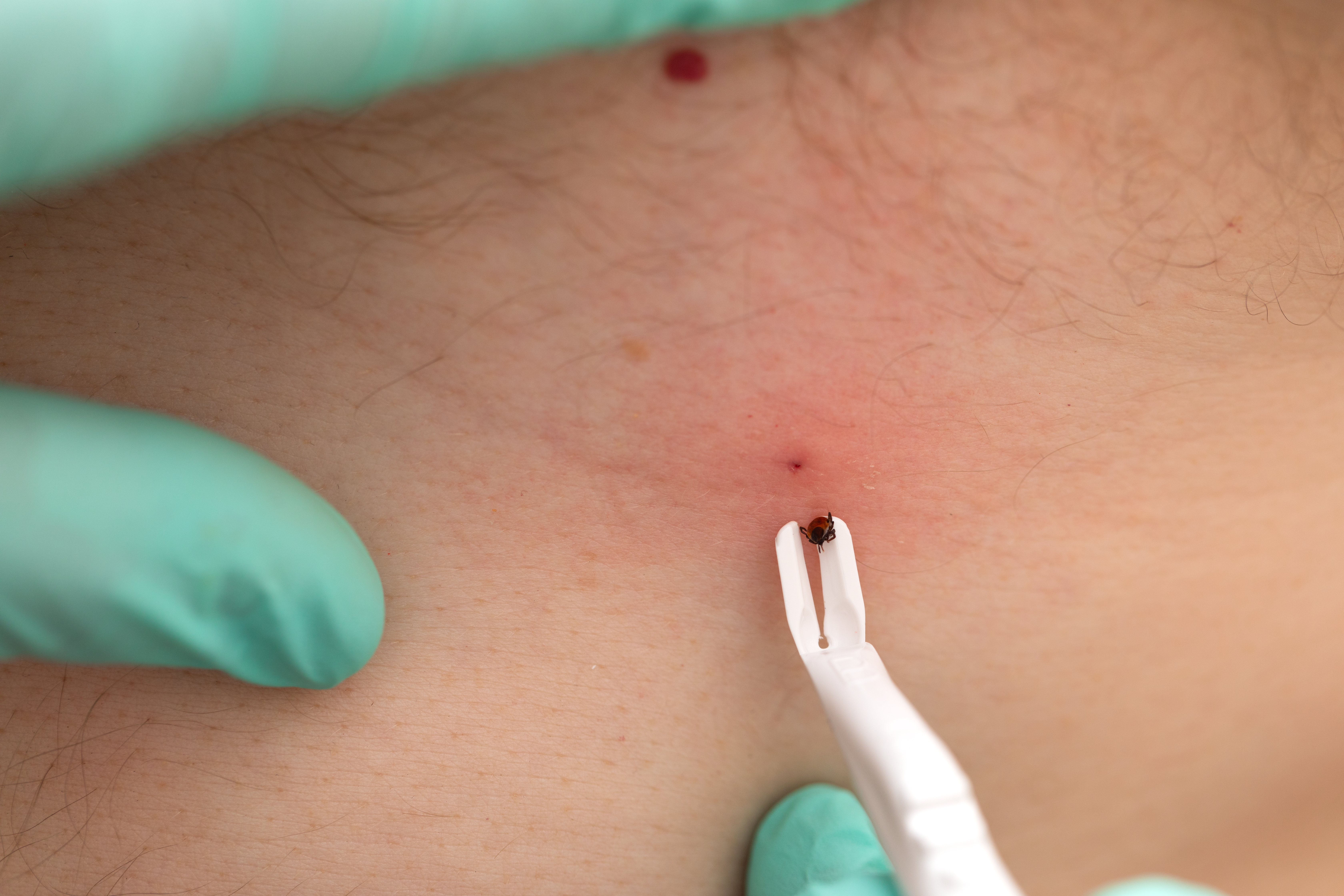 Pospite krpelja ovim sastojkom i sačekajte 20 minuta - tvrde da se sam izvlači