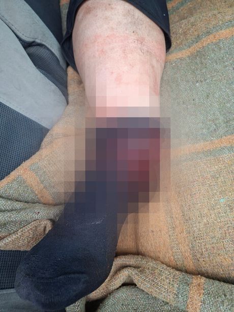 Vlase, Vranje, Hitna pomoć, pad u šumi, prelom, majka