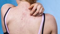 Zašto su akne na leđima toliko tvrdoglave? Ovih 7 promena u rutini daju rezultate već za par nedelja