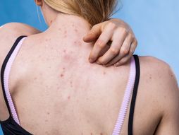 akne na leđima, akne, leđa, svrab, nega kože