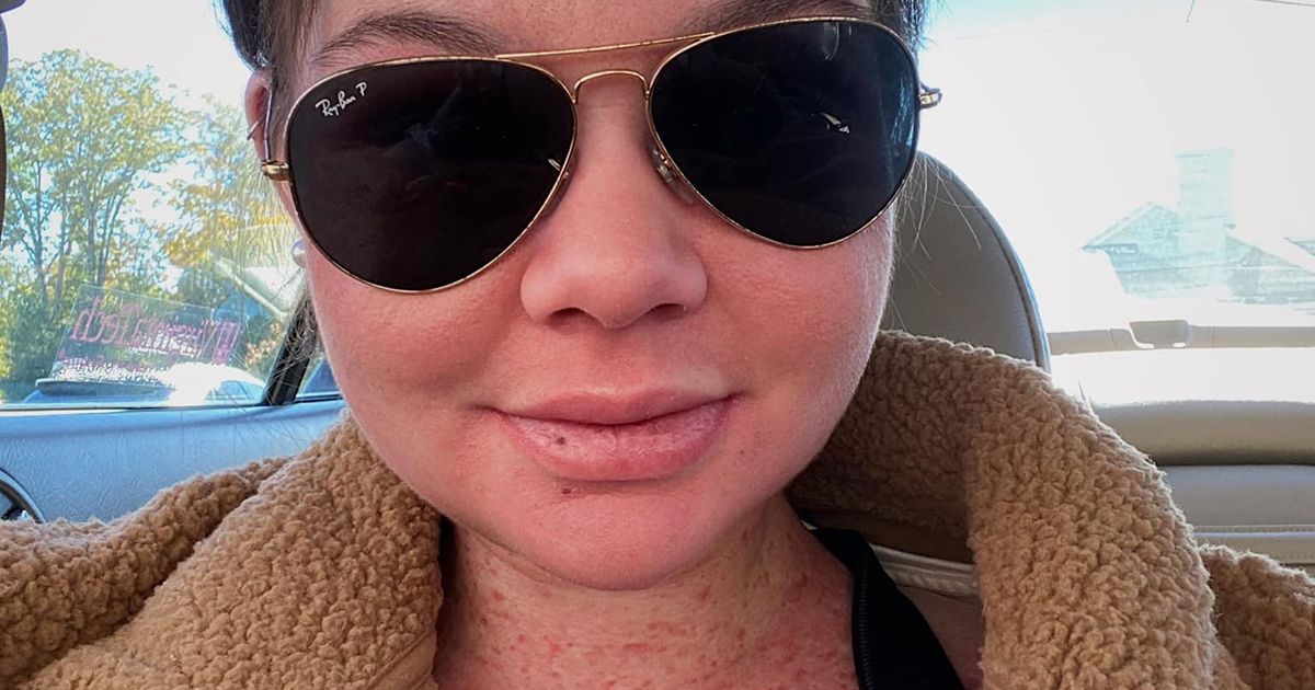 Koža joj gori za 15 sekundi na suncu: Kao vampir beži od svetlosti, a razlog je zastrašujući