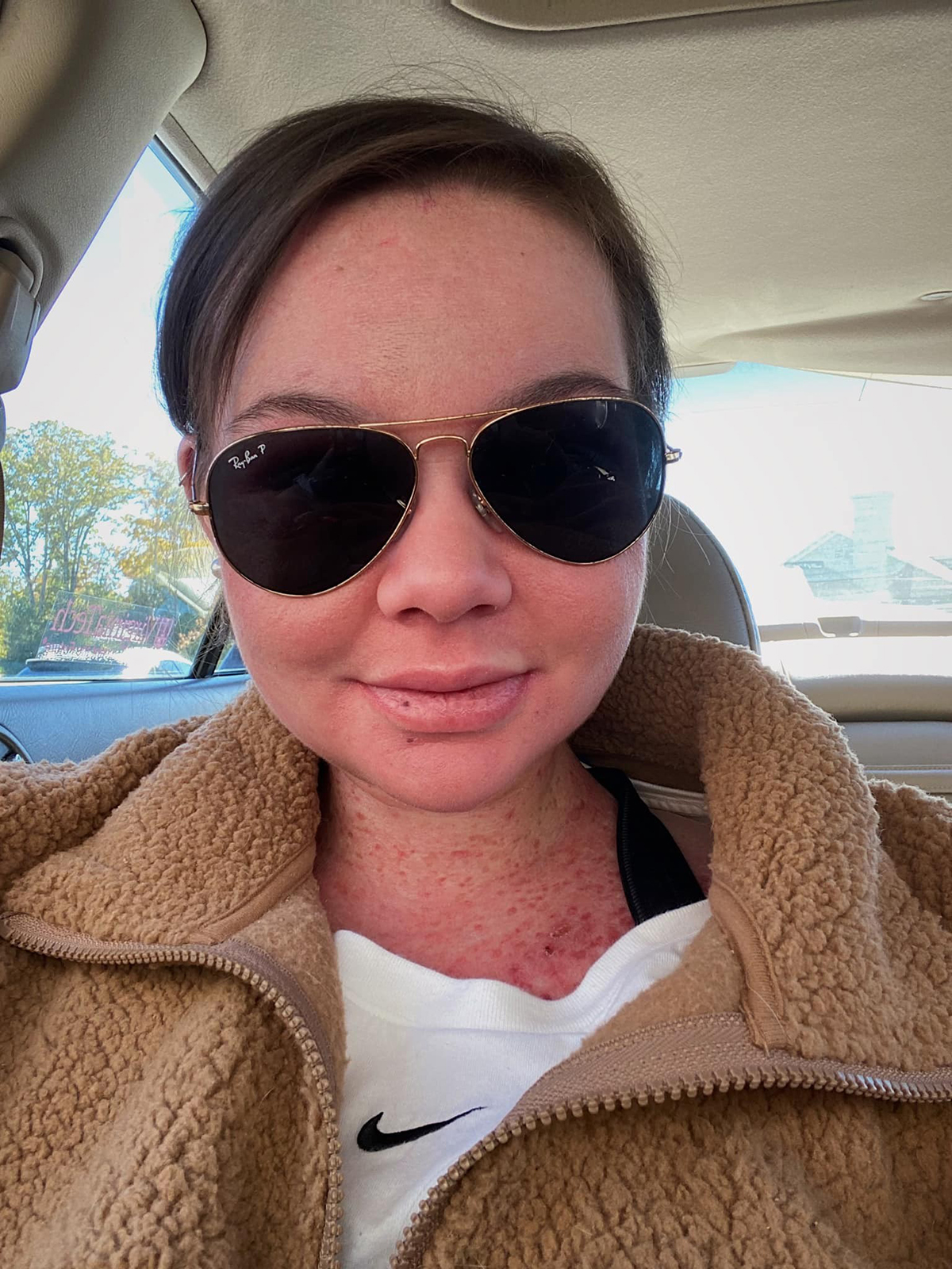 Koža joj gori za 15 sekundi na suncu: Kao vampir beži od svetlosti, a razlog je zastrašujući