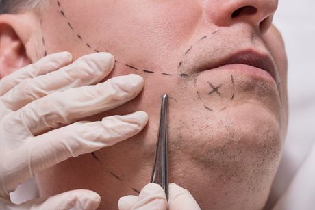 Operacija brade, jawline