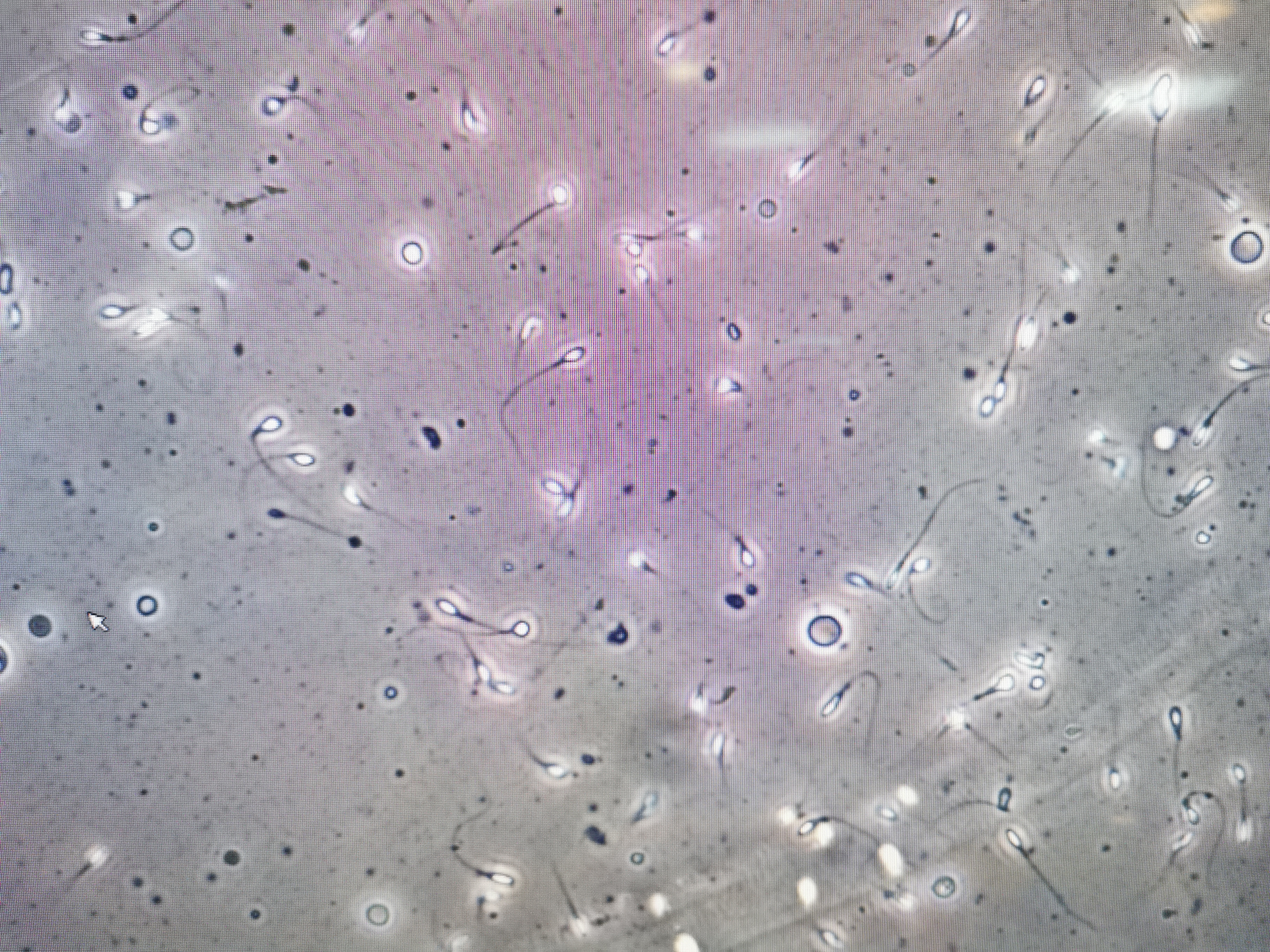 Revolucionarni medicinski poduhvat: Muškarac proizveo spermatozoide iz tkiva zamrznutog kad je bio dete