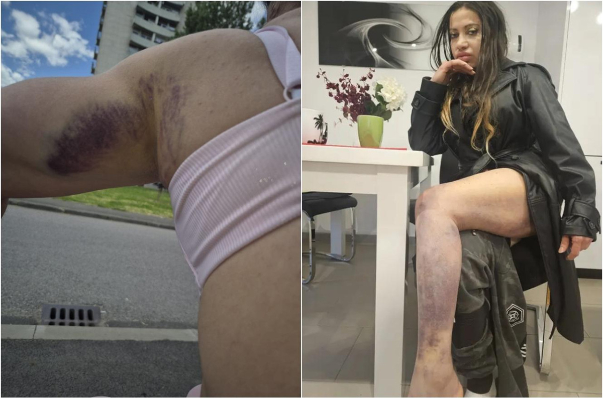 "Teror traje 15 godina" Pevačica brutalno pretučena, jezive scene u modricama "Manijaci će me osakatiti"
