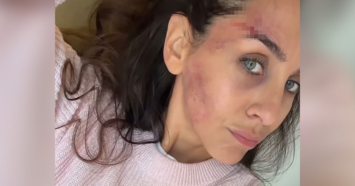 Ивана Дудич с синяками и царапинами на лице встревожила подписчиков: актриса рассказала, что с ней произошло