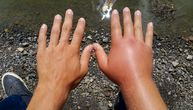 Crveni otok i svrab: Kako odmah prepoznati koji vas je od 10 letnjih insekata ujeo