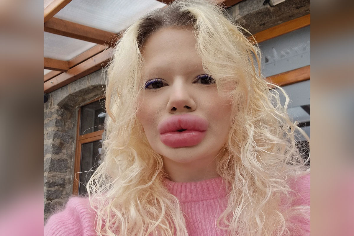 Žena sa najvećim usnama na svetu otkrila kako je nekada izgledala: Šta kažete na ovu razliku?
