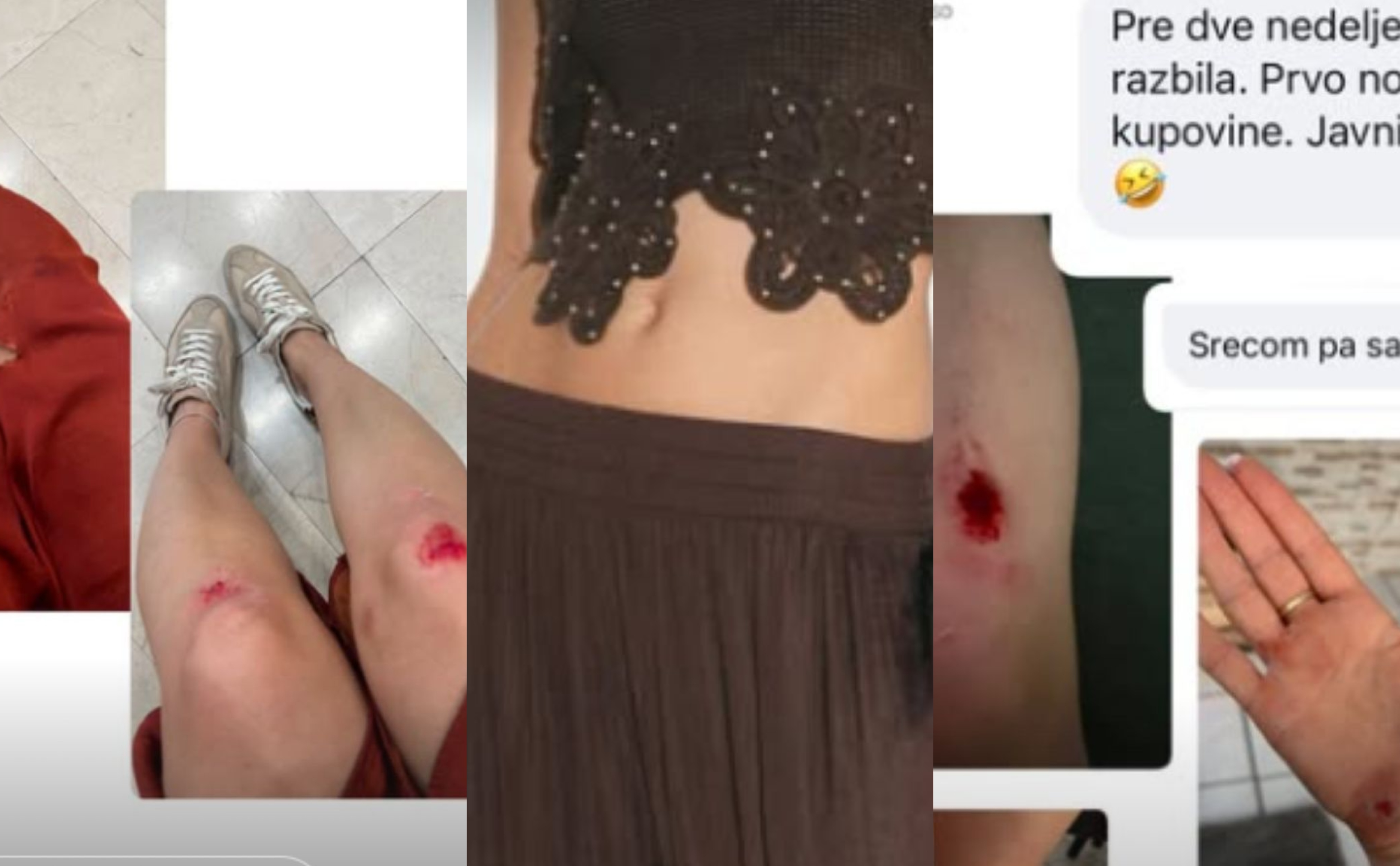 Zarine pantalone “smrti”: Žene prijavljuju padove zbog viralnih širokih pantalona, neke završile na operaciji