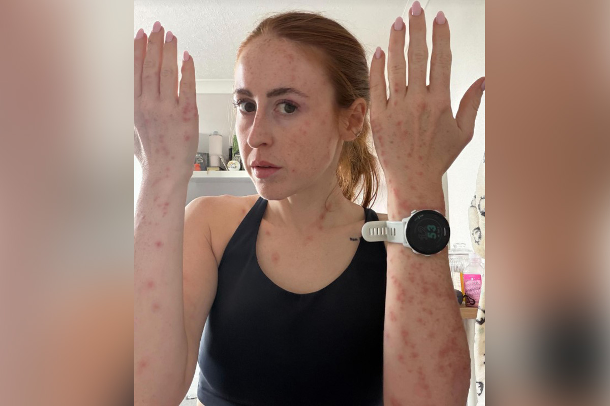 Devojku izujedale stenice u poznatom hotelu: Objavila fotografije tela, izgledaju jezivo