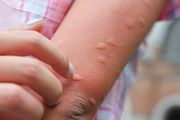 Niti je krema, niti skupa bočica iz apoteke, a svrab od ujeda komarca prestaje za 10 minuta: Spas je u špajzu