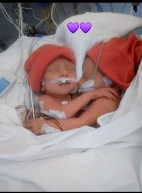 Valentina i Kristina, sijamske bliznakinje, na rođenju