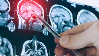 Moždana aneurizma: Ne daje simptome, ljudi i ne znaju da nose tempiranu bombu! Evo šta je savet neurohirurga
