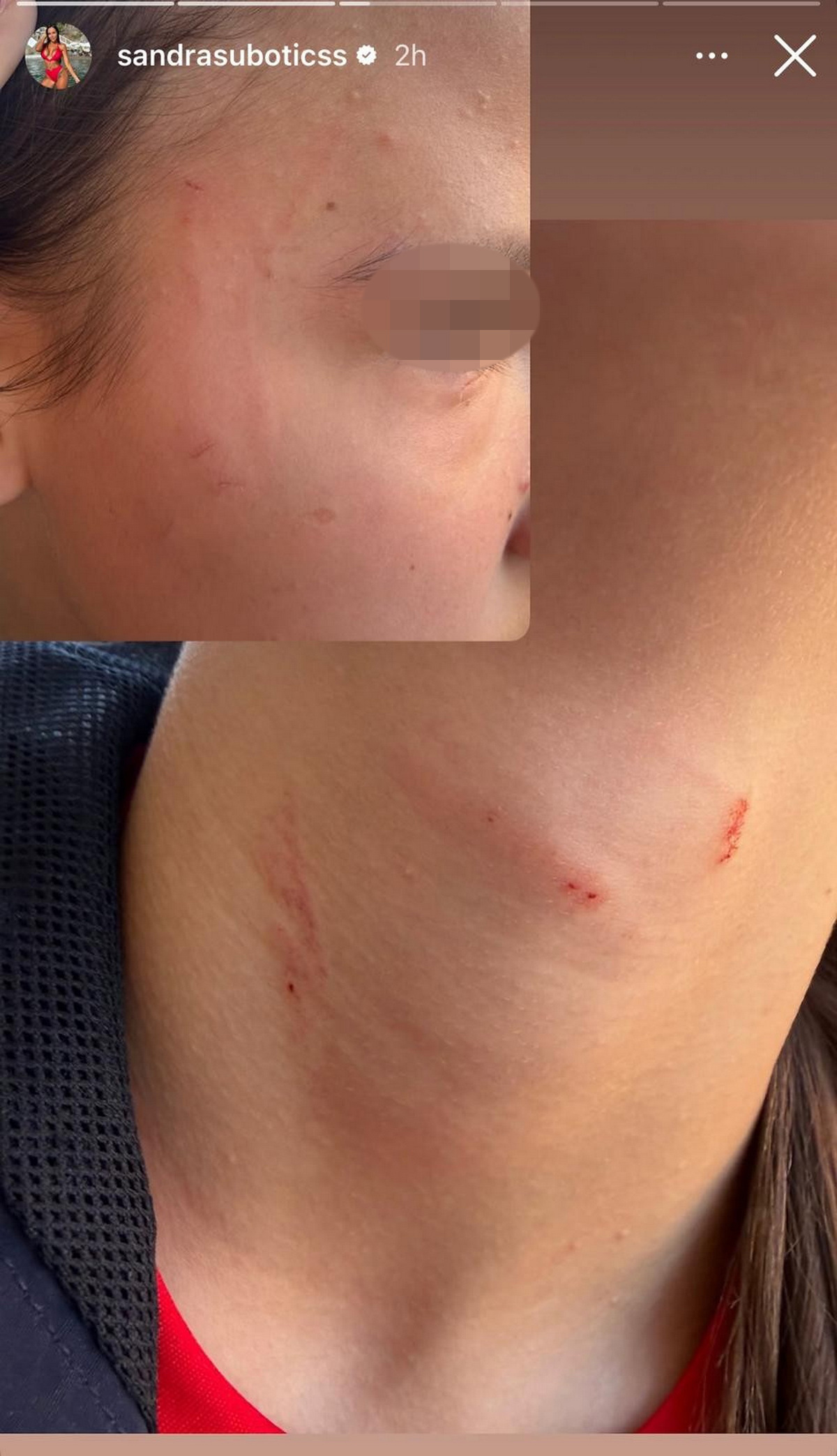 "MOJE DETE JE PRETUČENO" Aleksandra Subotić objavila potresne slike ćerke, na licu i vratu ogrebotine