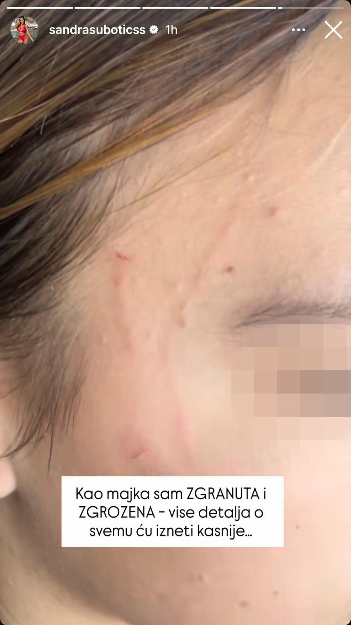 "MOJE DETE JE PRETUČENO" Aleksandra Subotić objavila potresne slike ćerke, na licu i vratu ogrebotine