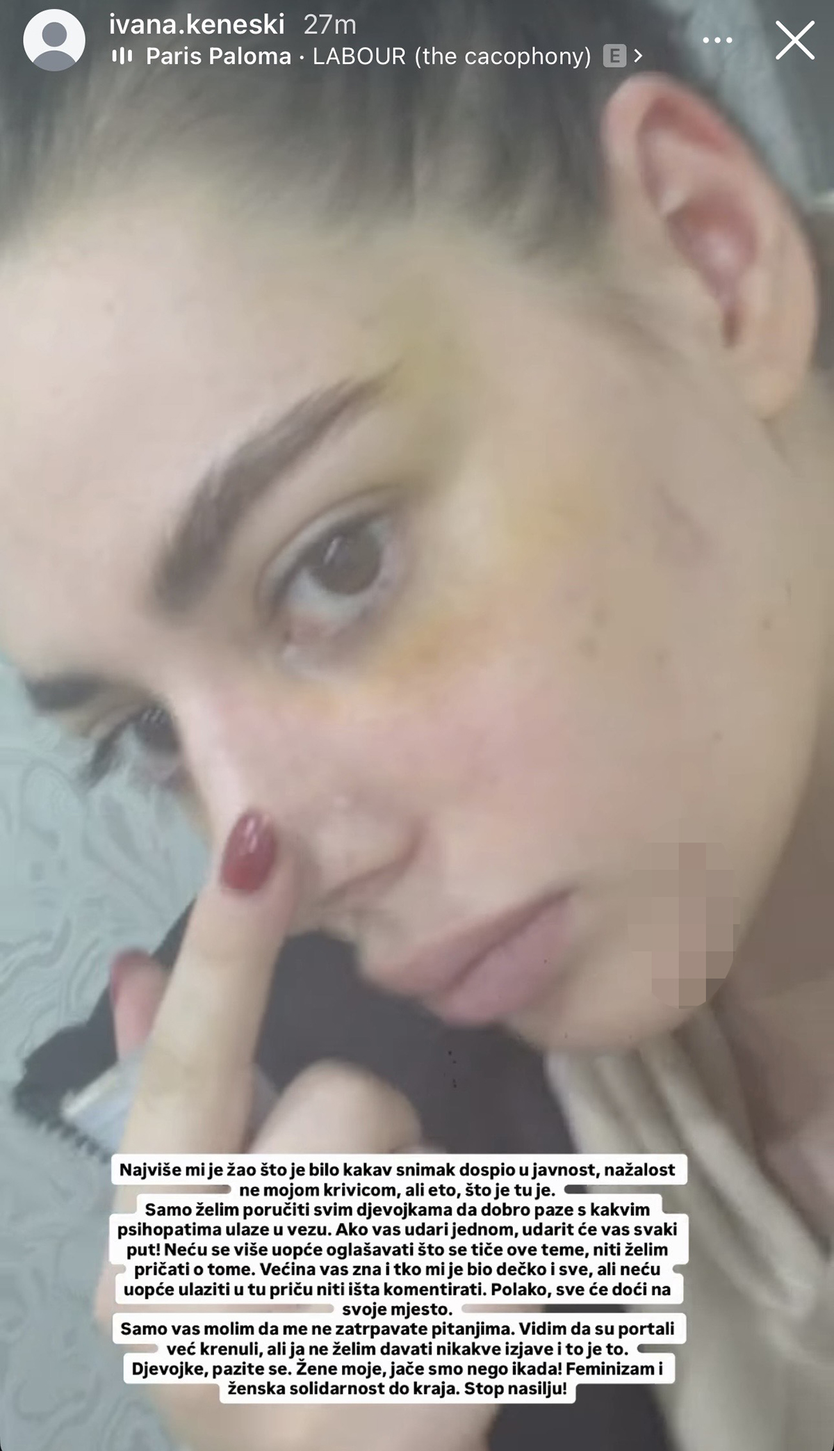 Jezive fotografije pretučene zadrugarke - lice u podlivima, oko poluzatvoreno: Oglasila se usred noći