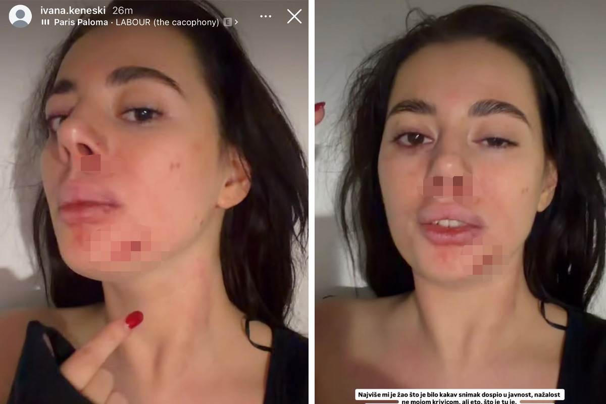 Jezive fotografije pretučene zadrugarke - lice u podlivima, oko poluzatvoreno: Oglasila se usred noći