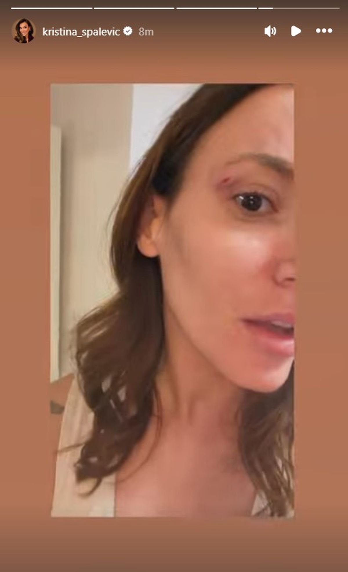 "Udario me, isekao": Kristini Spalević pukla arkada, hitno se oglasila i pokazala modricu!