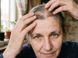 Proređena kosa